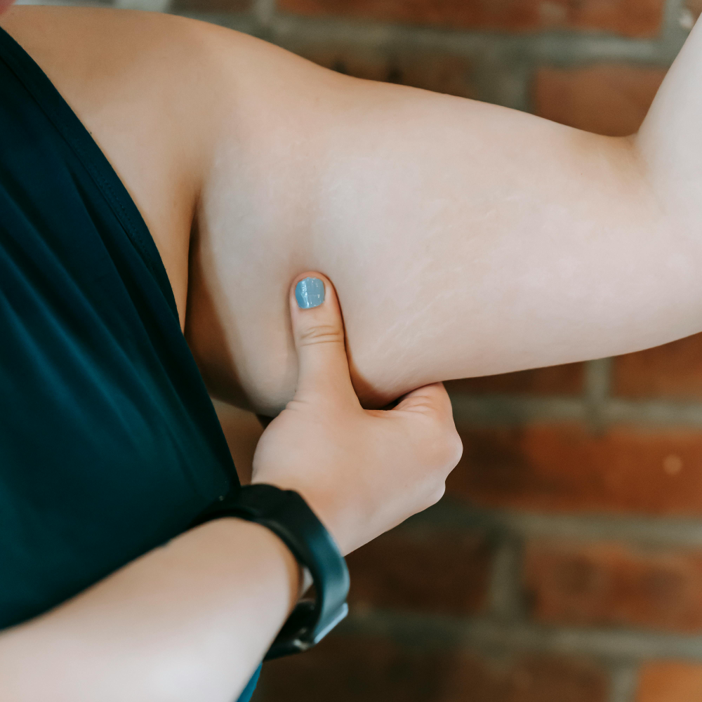 Person pinching the skin on their upper arm, showing some arm fat.